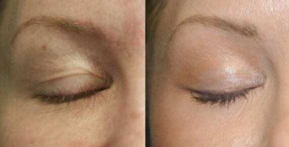Caring for areas near the eyes