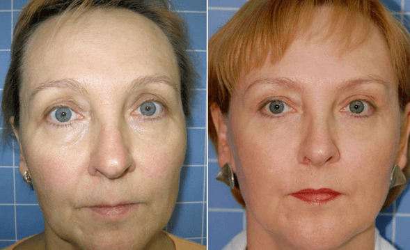 Before and after rejuvenation process