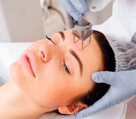 The essence of the fractional laser facial skin rejuvenation procedure