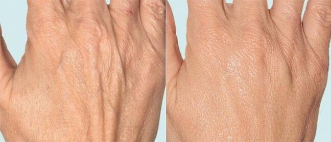 Hand skin before and after fractional therapy