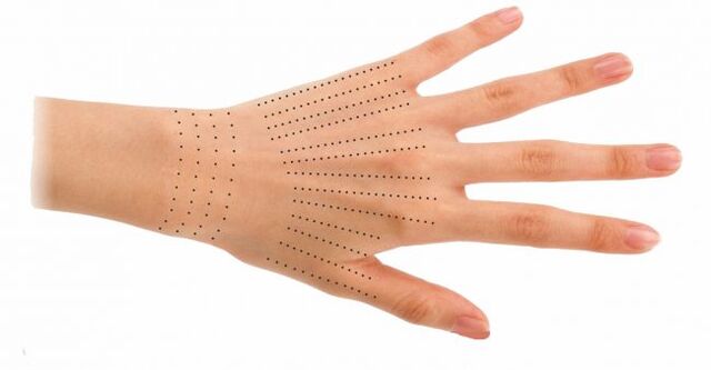 Places for injections on the hands during biorevitalization