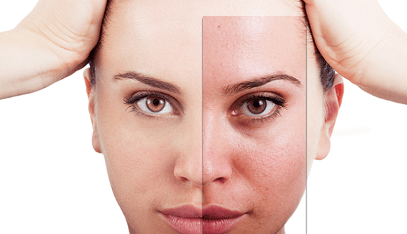 fractional rejuvenation removes the main aesthetic flaws on the face