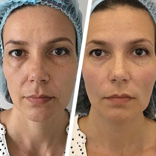 facial photography before and after laser rejuvenation