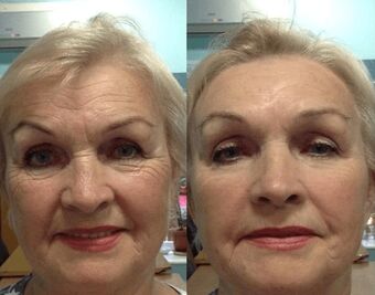experience of using anti-wrinkle cream Goji cream - personal photo before and after